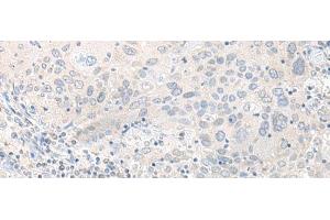Immunohistochemistry of paraffin-embedded Human cervical cancer tissue using TIMM8A Polyclonal Antibody at dilution of 1:50(x200) (TIMM8A/DDP 抗体)