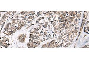 Immunohistochemistry of paraffin-embedded Human esophagus cancer tissue using CACNB3 Polyclonal Antibody at dilution of 1:55(x200) (CACNB3 抗体)