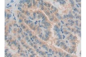 Detection of GDF10 in Human Thyroid cancer Tissue using Polyclonal Antibody to Growth Differentiation Factor 10 (GDF10) (GDF10 抗体  (AA 337-477))