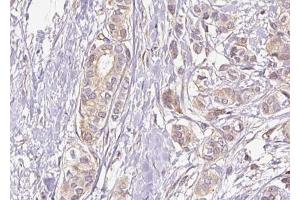 ABIN6267430 at 1/100 staining human breast carcinoma tissue sections by IHC-P. (NFKB1 抗体  (pSer337))