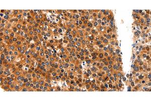 Immunohistochemistry of paraffin-embedded Human liver cancer tissue using FGFR1 Polyclonal Antibody at dilution 1:60 (FGFR1 抗体)