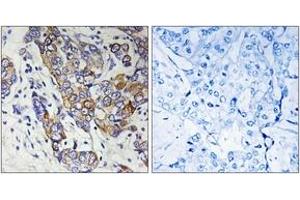 Immunohistochemistry analysis of paraffin-embedded human breast carcinoma tissue, using CBR1 Antibody. (CBR1 抗体  (AA 181-230))