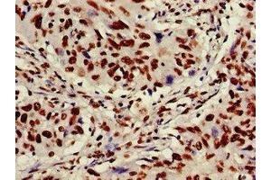 Immunohistochemistry of paraffin-embedded human lung cancer using ABIN7175905 at dilution of 1:100 (XRCC6 抗体  (AA 2-609))