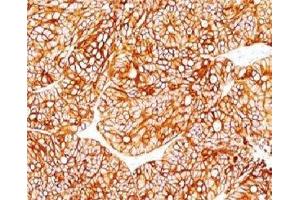 Formalin-fixed, paraffin-embedded human colon carcinoma stained with Cytokeratin 18 antibody. (Cytokeratin 18 抗体)