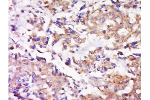 Paraformaldehyde-fixed, paraffin embedded human lung carcinoma, Antigen retrieval by boiling in sodium citrate buffer (pH6) for 15min, Block endogenous peroxidase by 3% hydrogen peroxide for 30 minutes, Blocking buffer (normal goat serum) at 37°C for 20min, Antibody incubation with Rabbit Anti-MEK1/2 Polyclonal Antibody, Unconjugated  at 1:500 overnight at 4°C, followed by a conjugated secondary and DAB staining. (MEK1/2 抗体  (AA 301-393))
