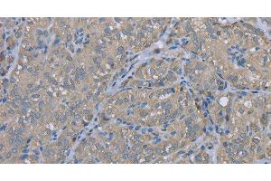 Immunohistochemistry of paraffin-embedded Human thyroid cancer using EZR Polyclonal Antibody at dilution of 1:30 (Ezrin 抗体)