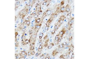 Immunohistochemistry of paraffin-embedded human liver using IGF2BP3 antibody (ABIN6131800, ABIN6142245, ABIN6142246 and ABIN6221706) at dilution of 1:100 (40x lens). (IGF2BP3 抗体  (AA 300-579))