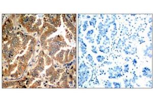 Immunohistochemical analysis of paraffin- embedded human lung carcinoma tissue using ADD1 (Ab-726) antibody (E021189). (alpha Adducin 抗体)