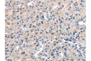 The image on the left is immunohistochemistry of paraffin-embedded Human liver cancer tissue using ABIN7127970(ITPA Antibody) at dilution 1/25, on the right is treated with fusion protein. (ITPA 抗体)