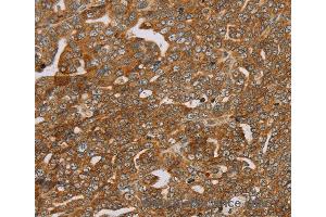 Immunohistochemistry of Human cervical cancer using PLEKHG6 Polyclonal Antibody at dilution of 1:45