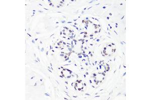 Immunohistochemistry of paraffin-embedded human breast using MonoMethyl-Histone H3-R17 antibody (ABIN3017467, ABIN3017468, ABIN3017469 and ABIN6220100) at dilution of 1:100 (40x lens).