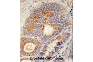 HHAT Antibody (N-term) (ABIN651694 and ABIN2840363) immunohistochemistry analysis in formalin fixed and paraffin embedded human prostate carcinoma followed by peroxidase conjugation of the secondary antibody and DAB staining. (HHAT 抗体  (N-Term))