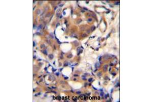 KNG1 Antibody immunohistochemistry analysis in formalin fixed and paraffin embedded human breast carcinoma followed by peroxidase conjugation of the secondary antibody and DAB staining. (KNG1 抗体  (N-Term))