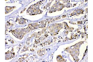 MUT was detected in paraffin-embedded sections of human lung cancer tissues using rabbit anti- MUT Antigen Affinity purified polyclonal antibody (Catalog # ) at 1 µg/mL.