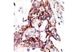 Formalin-fixed and paraffin-embedded human cancer tissue reacted with the primary antibody, which was peroxidase-conjugated to the secondary antibody, followed by DAB staining. (ARL3 抗体  (C-Term))