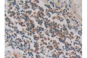 IHC-P analysis of Human Stomach cancer Tissue, with DAB staining. (PKIG 抗体  (AA 1-76))