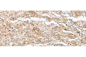 Immunohistochemistry of paraffin-embedded Human cervical cancer tissue using TTC12 Polyclonal Antibody at dilution of 1:40(x200) (TTC12 抗体)