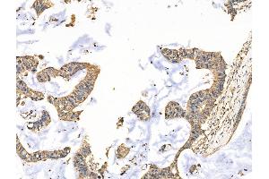 ABIN7094580 and ABIN7098629 at 1/100 staining Human colorectal cancer by IHC-P.