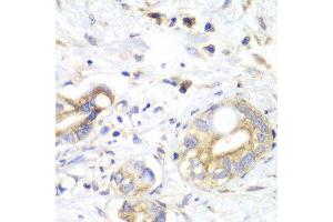 Immunohistochemistry of paraffin-embedded human liver cancer using TXN2 antibody at dilution of 1:100 (x40 lens).