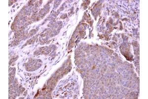IHC-P Image CXCR1 antibody [C2C3], C-term detects CXCR1 protein at cytosol on human breast carcinoma by immunohistochemical analysis. (CXCR1 抗体  (C-Term))