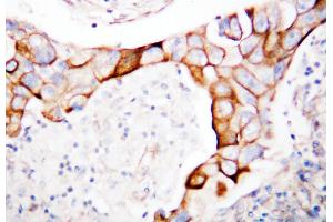 Anti-CD18 antibody, IHC(P) IHC(P): Human Mammary Cancer Tissue