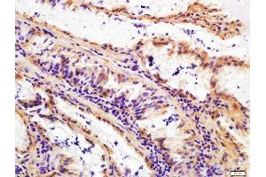 Paraformaldehyde-fixed, paraffin embedded human gastric cancer, Antigen retrieval by boiling in sodium citrate buffer (pH6) for 15min, Block endogenous peroxidase by 3% hydrogen peroxide for 30 minutes, Blocking buffer (normal goat serum) at 37°C for 20min, Antibody incubation with Rabbit Anti-FAPA Polyclonal Antibody, Unconjugated  at 1:200 overnight at 4°C, followed by a conjugated secondary for 90 minutes and DAB staining. (FAP 抗体  (AA 311-410))