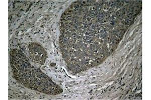Immunohistochemical analysis of paraffin-embedded human breast carcinoma tissue using NFκB-p65 (Phospho-Ser536) Antibody. (NF-kB p65 抗体  (pSer536))