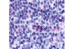 Anti-GPR65 antibody  ABIN1048859 IHC staining of human lymph node, hodgkin's disease. (GPR65 抗体  (Cytoplasmic Domain))