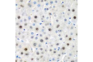 Immunohistochemistry of paraffin-embedded human liver cancer using LMX1B antibody (ABIN5975264) at dilution of 1/200 (40x lens). (LMX1B 抗体)