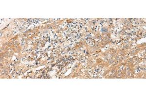Immunohistochemistry of paraffin-embedded Human cervical cancer tissue using GALP Polyclonal Antibody at dilution of 1:45(x200) (GALP 抗体)