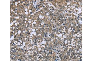 Immunohistochemistry of Human cervical cancer using PTK2B Polyclonal Antibody at dilution of 1:50 (PTK2B 抗体)