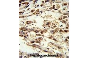 Formalin-fixed and paraffin-embedded human hepatocarcinoma reacted with AIFM2 Antibody (C-term), which was peroxidase-conjugated to the secondary antibody, followed by DAB staining. (AIFM2 抗体  (C-Term))