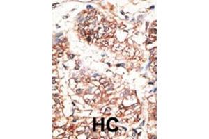 Formalin-fixed and paraffin-embedded human cancer tissue reacted with the primary antibody, which was peroxidase-conjugated to the secondary antibody, followed by AEC staining. (Neuregulin 3 抗体  (AA 305-336))