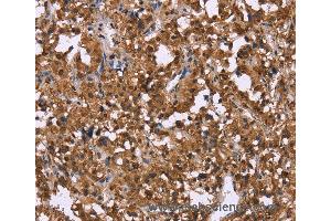 Immunohistochemistry of Human liver cancer using GPR171 Polyclonal Antibody at dilution of 1:40 (GPR171 抗体)