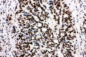 Anti-Ku80 antibody, IHC(P) IHC(P): Human Mammary Cancer Tissue (XRCC5 抗体  (C-Term))