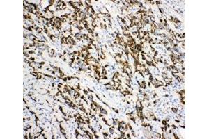 IHC-P: DCI antibody testing of human breast cancer tissue