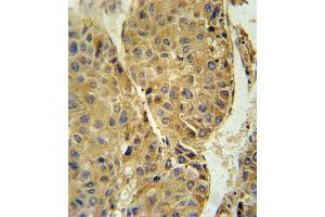 TUBB3 Antibody (N-term) (ABIN651938 and ABIN2840464) immunohistochemistry analysis in formalin fixed and paraffin embedded human hepatocarcinoma followed by peroxidase conjugation of the secondary antibody and DAB staining. (TUBB3 抗体  (AA 36-63))