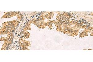 Immunohistochemistry of paraffin-embedded Human prost ate cancer tissue using RPS11 Polyclonal Antibody at dilution of 1:40(x200) (RPS11 抗体)