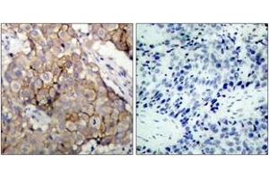 Immunohistochemistry analysis of paraffin-embedded human breast carcinoma tissue, using EGFR (Ab-1092) Antibody. (EGFR 抗体  (AA 1061-1110))