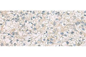 Immunohistochemistry of paraffin-embedded Human liver cancer tissue using CHMP6 Polyclonal Antibody at dilution of 1:65(x200) (CHMP6 抗体)