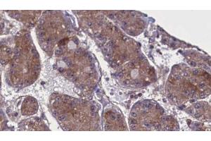 ABIN6277722 at 1/100 staining Human liver cancer tissue by IHC-P. (SPRY4 抗体  (Internal Region))
