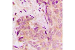 Immunohistochemical analysis of TGF beta 1 staining in human breast cancer formalin fixed paraffin embedded tissue section. (TGFB1 抗体  (C-Term))
