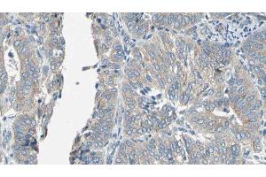 ABIN6276939 at 1/100 staining Human cervical cancer tissue by IHC-P. (EPXH2 抗体)