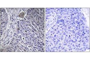 Immunohistochemistry analysis of paraffin-embedded human lung carcinoma tissue, using HNRPDL Antibody. (HNRPDL 抗体  (AA 241-290))