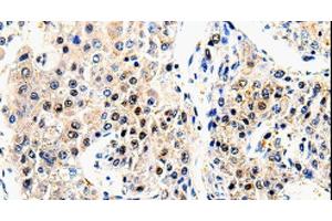 Immunohistochemistry of paraffin-embedded Human liver cancer using beta Amyloid Polyclonal Antibody at dilution of 1:100 (beta Amyloid 抗体)