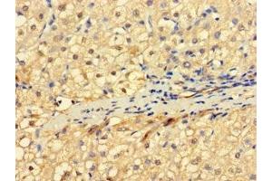 Immunohistochemistry of paraffin-embedded human liver cancer using ABIN7151164 at dilution of 1:100 (RNF182 抗体  (AA 1-160))