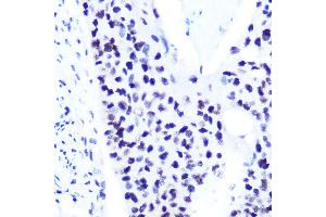 Immunohistochemistry of paraffin-embedded human esophageal cancer using Phospho-ST-S727 Rabbit mAb (ABIN7270300) at dilution of 1:100 (40x lens). (STAT1 抗体  (pSer727))