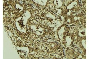 ABIN6273227 at 1/100 staining Human breast cancer tissue by IHC-P. (DIS3 抗体  (Internal Region))
