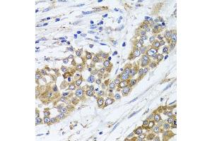 Immunohistochemistry of paraffin-embedded human colon carcinoma using PEX14 antibody. (PEX14 抗体)