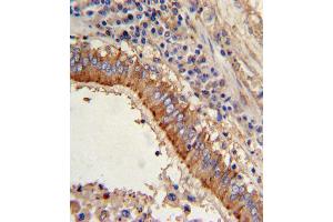 Formalin-fixed and paraffin-embedded human lung carcinoma with MVP Antibody (C-term), which was peroxidase-conjugated to the secondary antibody, followed by DAB staining. (MVP 抗体  (C-Term))